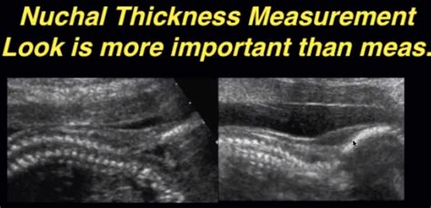 nuchal skinfold thickness measurement|nuchal fold measurement 20 weeks.